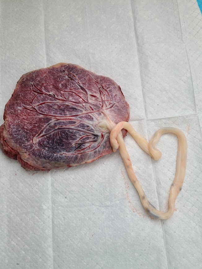 Placenta in a heart shape