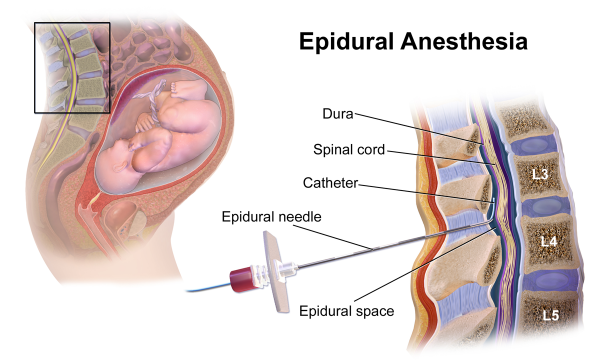 Epidural diagram